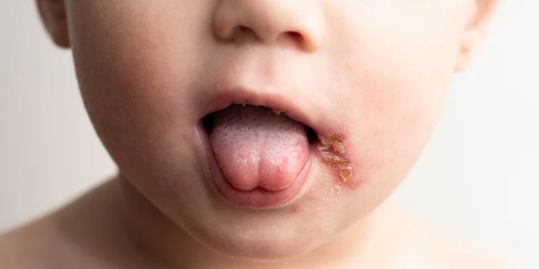 Penyebab herpes pada anak harus dipantau, kenali gejalanya